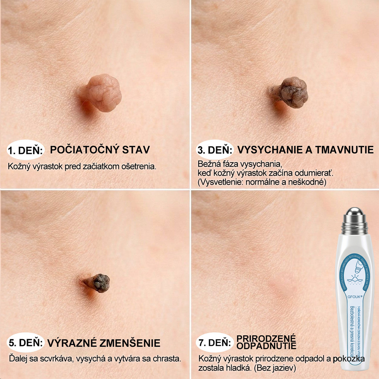 𝑶𝒇𝒊𝒄𝒊á𝒍𝒏𝒚 𝒐𝒃𝒄𝒉𝒐𝒅 ✅️ | GFOUK® 7-𝒅ň𝒐𝒗ý 𝒑𝒓í𝒑𝒓𝒂𝒗𝒐𝒌 𝒏𝒂 𝒐𝒅𝒔𝒕𝒓á𝒏𝒆𝒏𝒊𝒆 𝒌𝒐ž𝒏ý𝒄𝒉 𝒗ý𝒓𝒂𝒔𝒕𝒌𝒐𝒗 𝒂 𝒑𝒊𝒈𝒎𝒆𝒏𝒕𝒐𝒗ý𝒄𝒉 š𝒌𝒗ŕ𝒏👩‍⚕️ (𝒃𝒆𝒛 𝒃𝒐𝒍𝒆𝒔𝒕𝒊, 𝒃𝒆𝒛 𝒋𝒂𝒛𝒊𝒆𝒗, 𝒑𝒓𝒆𝒔𝒏ý 𝒓𝒐𝒍𝒍-𝒐𝒏 𝒂𝒑𝒍𝒊𝒌á𝒕𝒐𝒓) 🔥