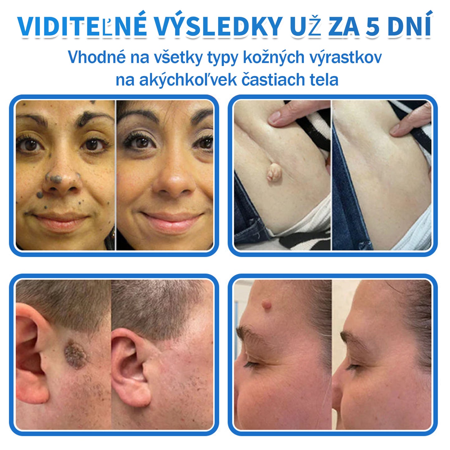 🫶📕 Náplasť DR.Fachmer® 2 v 1 s mikroihličkami a hydrokoloidom |👉 Odstraňovač vyvýšených materských znamienok, akné, plochých bradavíc a kožných výrastkov | Zlepšuje vrásky, jazvy a škvrny | Neviditeľné náplasti na pupienky na tvár a telo