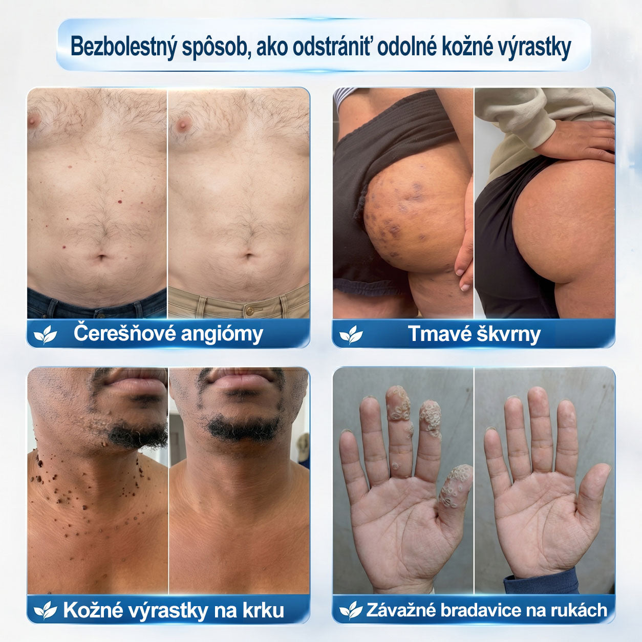 𝑶𝒇𝒊𝒄𝒊á𝒍𝒏𝒚 𝒐𝒃𝒄𝒉𝒐𝒅 ✅️ | GFOUK® 7-𝒅ň𝒐𝒗ý 𝒑𝒓í𝒑𝒓𝒂𝒗𝒐𝒌 𝒏𝒂 𝒐𝒅𝒔𝒕𝒓á𝒏𝒆𝒏𝒊𝒆 𝒌𝒐ž𝒏ý𝒄𝒉 𝒗ý𝒓𝒂𝒔𝒕𝒌𝒐𝒗 𝒂 𝒑𝒊𝒈𝒎𝒆𝒏𝒕𝒐𝒗ý𝒄𝒉 š𝒌𝒗ŕ𝒏👩‍⚕️ (𝒃𝒆𝒛 𝒃𝒐𝒍𝒆𝒔𝒕𝒊, 𝒃𝒆𝒛 𝒋𝒂𝒛𝒊𝒆𝒗, 𝒑𝒓𝒆𝒔𝒏ý 𝒓𝒐𝒍𝒍-𝒐𝒏 𝒂𝒑𝒍𝒊𝒌á𝒕𝒐𝒓) 🔥