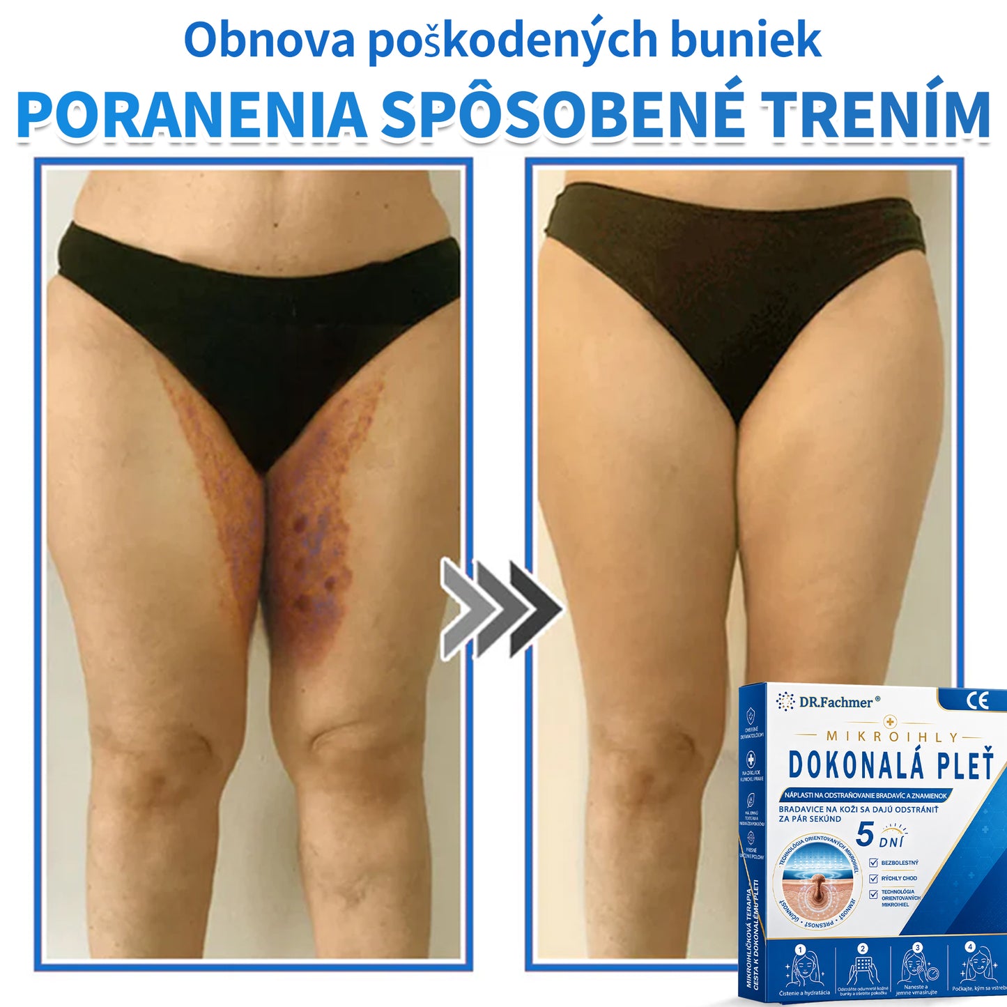 🫶📕 Náplasť DR.Fachmer® 2 v 1 s mikroihličkami a hydrokoloidom |👉 Odstraňovač vyvýšených materských znamienok, akné, plochých bradavíc a kožných výrastkov | Zlepšuje vrásky, jazvy a škvrny | Neviditeľné náplasti na pupienky na tvár a telo