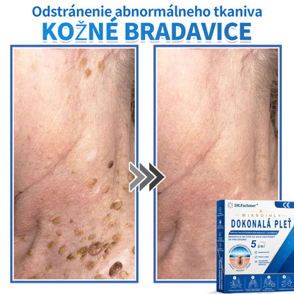 🫶📕 Náplasť DR.Fachmer® 2 v 1 s mikroihličkami a hydrokoloidom |👉 Odstraňovač vyvýšených materských znamienok, akné, plochých bradavíc a kožných výrastkov | Zlepšuje vrásky, jazvy a škvrny | Neviditeľné náplasti na pupienky na tvár a telo